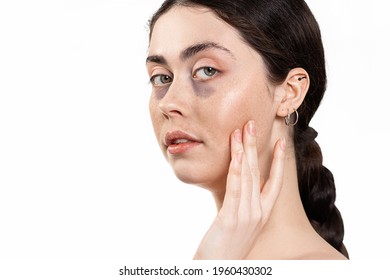 Portrait Of A Young Beautiful Woman With Dark Circles Under Her Eyes. Isolated On A White Background. The Concept Of Beauty And Skin Care.