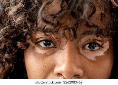 Portrait of young Brazilian woman with Vitiligo on face and eyes contour, close up of details of skin, eyes and curly hair, copyspace - Powered by Shutterstock