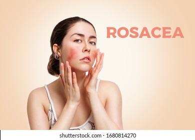 Portrait of a young Caucasian woman showing redness and inflamed blood vessels on her cheeks. The inscription rosacea. Beige background. The concept of rosacea and couperose