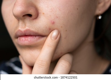 portrait of a young girl with problem skin. pimples on the chin. facial skin care. acne problem.
 - Shutterstock ID 1874122501