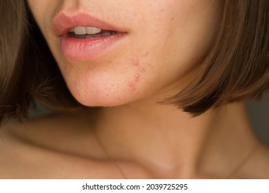 portrait of a young girl with problem skin.
chin acne problem. pimples on the beard. problem skin in a young girl. hormonal disbalance
 - Shutterstock ID 2039725295