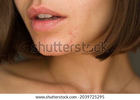 portrait of a young girl with problem skin.
chin acne problem. pimples on the beard. problem skin in a young girl. hormonal disbalance

