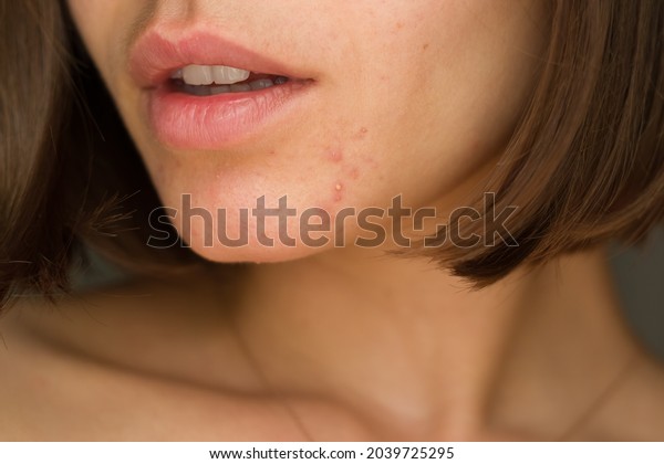 portrait of a young girl with problem\
skin.\
chin acne problem. pimples on the beard. problem skin in a\
young girl. hormonal\
disbalance\
