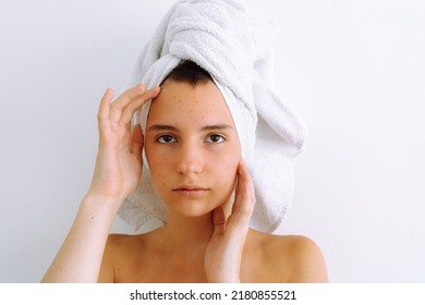 Portrait of young teenage girl with brown eyes, in bath towel on hair, with teenage acne, varicella zoster varicella zoster virus, age spots on face. Problematic teenage skin, Caucasian female model