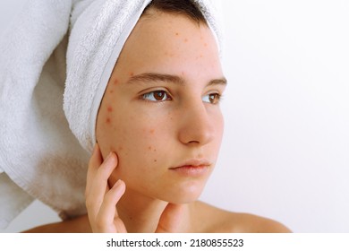 Portrait of young teenage girl with brown eyes, in bath towel on hair, with teenage acne, varicella zoster varicella zoster virus, age spots on face. Problematic teenage skin, Caucasian female model