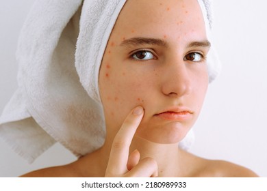 Portrait of young teenage girl with brown eyes, in bath towel on hair, with teenage acne, varicella zoster varicella zoster virus, age spots on face. Beautiful young Caucasian female model