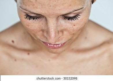 A Portrait Of A Young Woman With A Sunburn On Her Face.