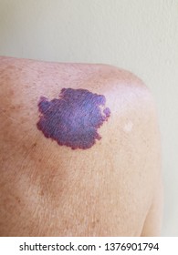 A Port-wine Stain Or Naevus Flammeus Is A Vascular Birthmark Consisting Of Superficial And Deep Dilated Capillaries In The Skin Which Produce A Reddish To Purplish Discolouration Of The Skin.
