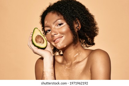 Positive African American Woman With Vitiligo Disease Holds Avocado Near Her Face. Cosmetics With Avocado For Pigmented Skin