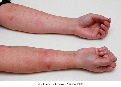 Positive Allergy Skin Test In A Male Patient