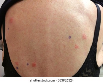 Positive Skin Patch Test in a Patient with Contact Dermatitis