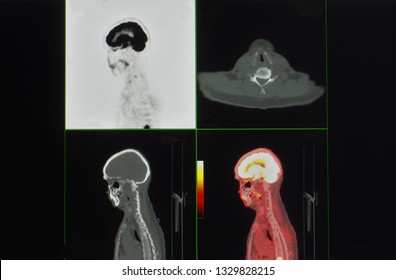 Positron Emission Tomography And Computer Tomography Images Or PET CT Scan Showing Brain Anatomy And Function