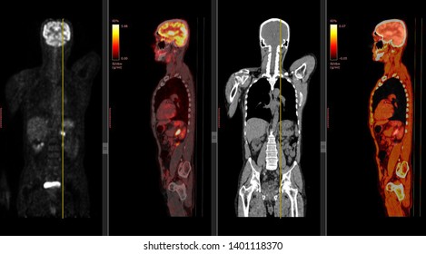 Positron Emission Tomography Or PET CT Scan Of Human Body (High Resolution)