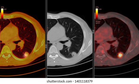 Positron Emission Tomography Or PET CT Scan Of Human Body (High Resolution)