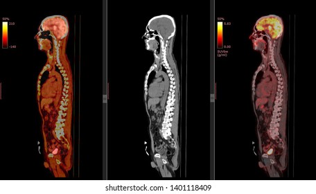 Positron Emission Tomography Or PET CT Scan Of Human Body (High Resolution)