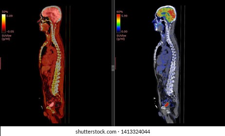 Positron Emission Tomography Or PET CT Scan Of Human Body (High Resolution)