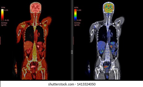 Positron Emission Tomography Or PET CT Scan Of Human Body (High Resolution)