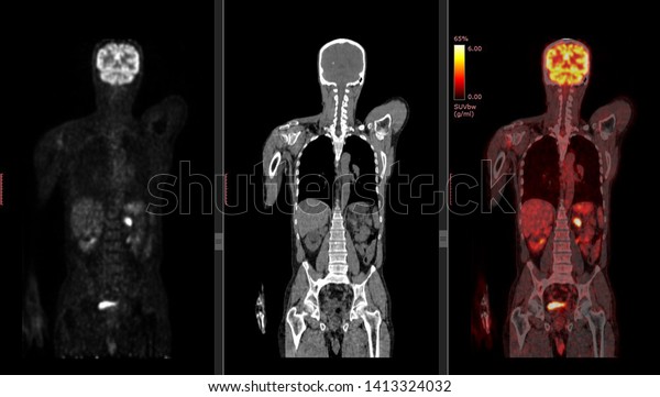 Positron Emission Tomography or PET CT Scan\
of Human Body (High\
Resolution)
