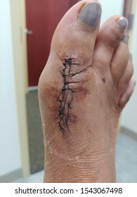 Post Op Stitches From Foot Surgery For Bunion