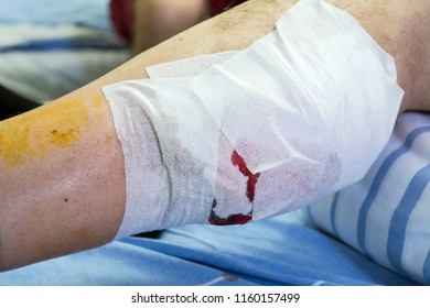 Post Operation Of A Hematoma At The Muscle Of The Leg 