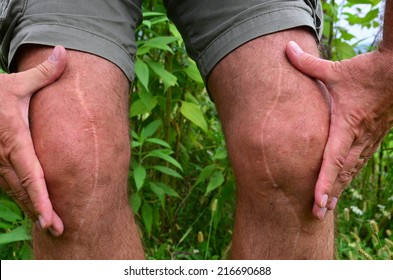 Post Surgery Scars, Many Years After Knee Reconstruction Surgery