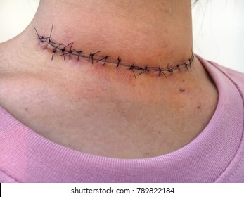 Post Surgical Scar At Neck After Thyroid Surgery In An  Asian Woman