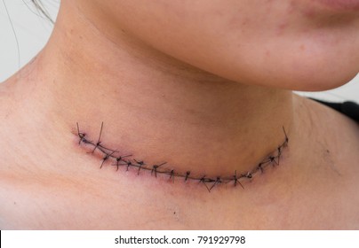 Post Surgical Scar At Neck After Thyroid Surgery In An Asian Woman.Medical Concept.