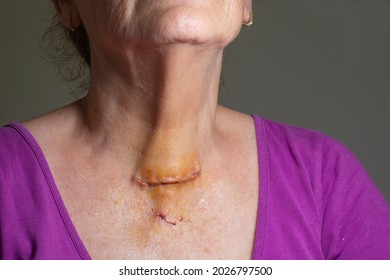 Post Surgical Scar On Woman Neck After Thyroid Surgery
