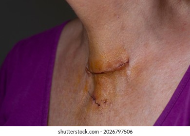 Post Surgical Scar On Woman Neck After Thyroid Surgery
