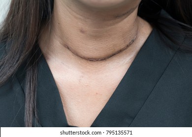 Post Surgical Scar On Woman Neck After Thyroid Surgery