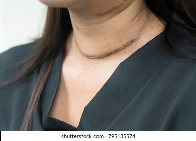 Post Surgical Scar On Woman Neck After Thyroid Surgery