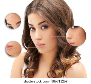 Post-Acne Marks /Treating Acne Scars