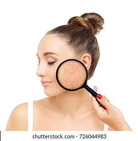 Post-Acne Marks /Treating Acne Scars.