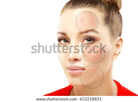 Post-Acne Marks /Treating Acne Scars