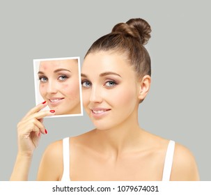 Post-Acne Marks /Treating Acne Scars.Acne Scar Removal