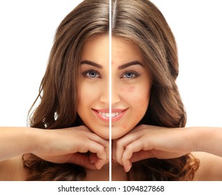 Post-Acne Marks /Treating Acne Scars.Acne Scar Removal