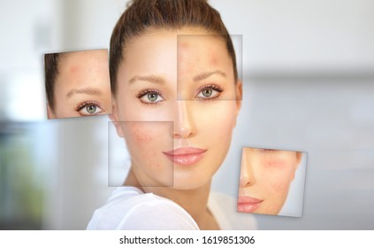 Postacne Marks Treating Acne Scarsacne Scar Stock Photo 1619851306 ...