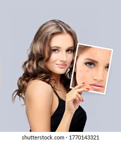 Post-Acne Marks /Treating Acne Scars.Acne Scar Removal	