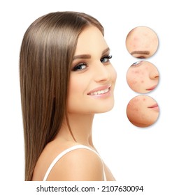 Post-Acne Marks ,Treating Acne Scars.Acne Scar Removal