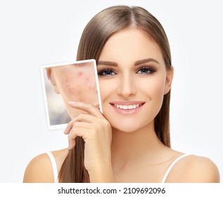 Post-Acne Marks ,Treating Acne Scars.Acne Scar Removal - Shutterstock ID 2109692096