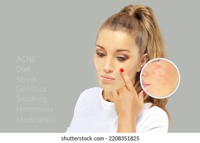 Post-Acne Marks .Treating Acne Scars.Acne Scar Removal	