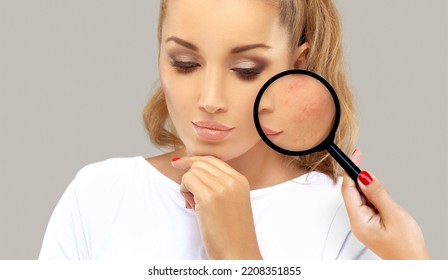 Post-Acne Marks .Treating Acne Scars.Acne Scar Removal	