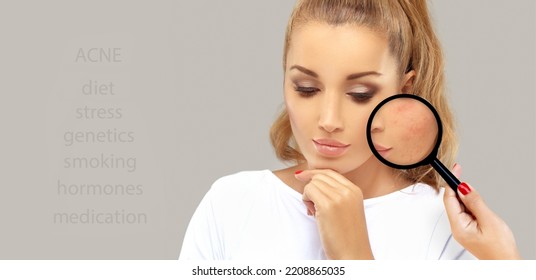 Post-Acne Marks .Treating Acne Scars.Acne Scar Removal	