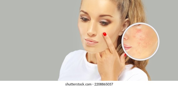 Post-Acne Marks .Treating Acne Scars.Acne Scar Removal	