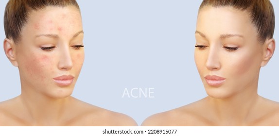 Post-Acne Marks .Treating Acne Scars.Acne Scar Removal	