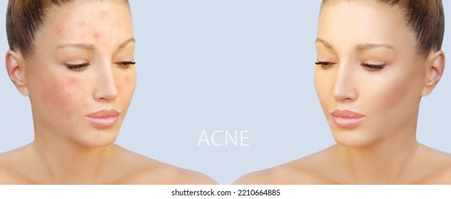 Post-Acne Marks .Treating Acne Scars.Acne Scar Removal	