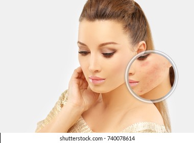 Post-Acne Marks /Treating Acne Scars.Acne Scar Removal