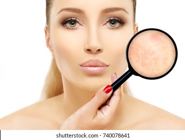 Post-Acne Marks /Treating Acne Scars.Acne Scar Removal