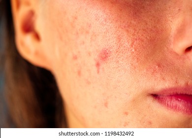 acne pock marks