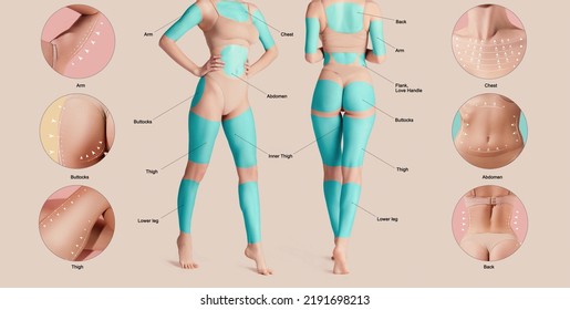 Poster with female body with marked areas for lifting procedures. Base fat problems areas of human body. Body shaping, liposuction, skin tightening, plastic surgery. - Shutterstock ID 2191698213